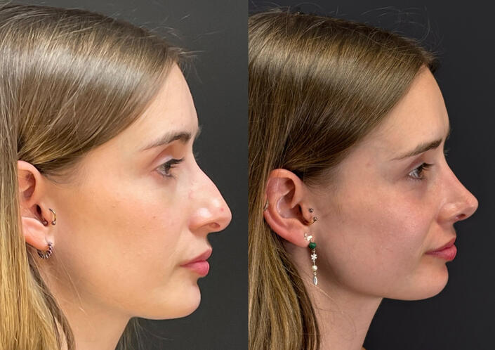 Rinoplastia Ultrasónica